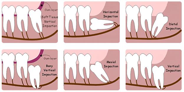 Surgical Removal Of Wisdom Teeth Gold Coast Oral Maxillofacial