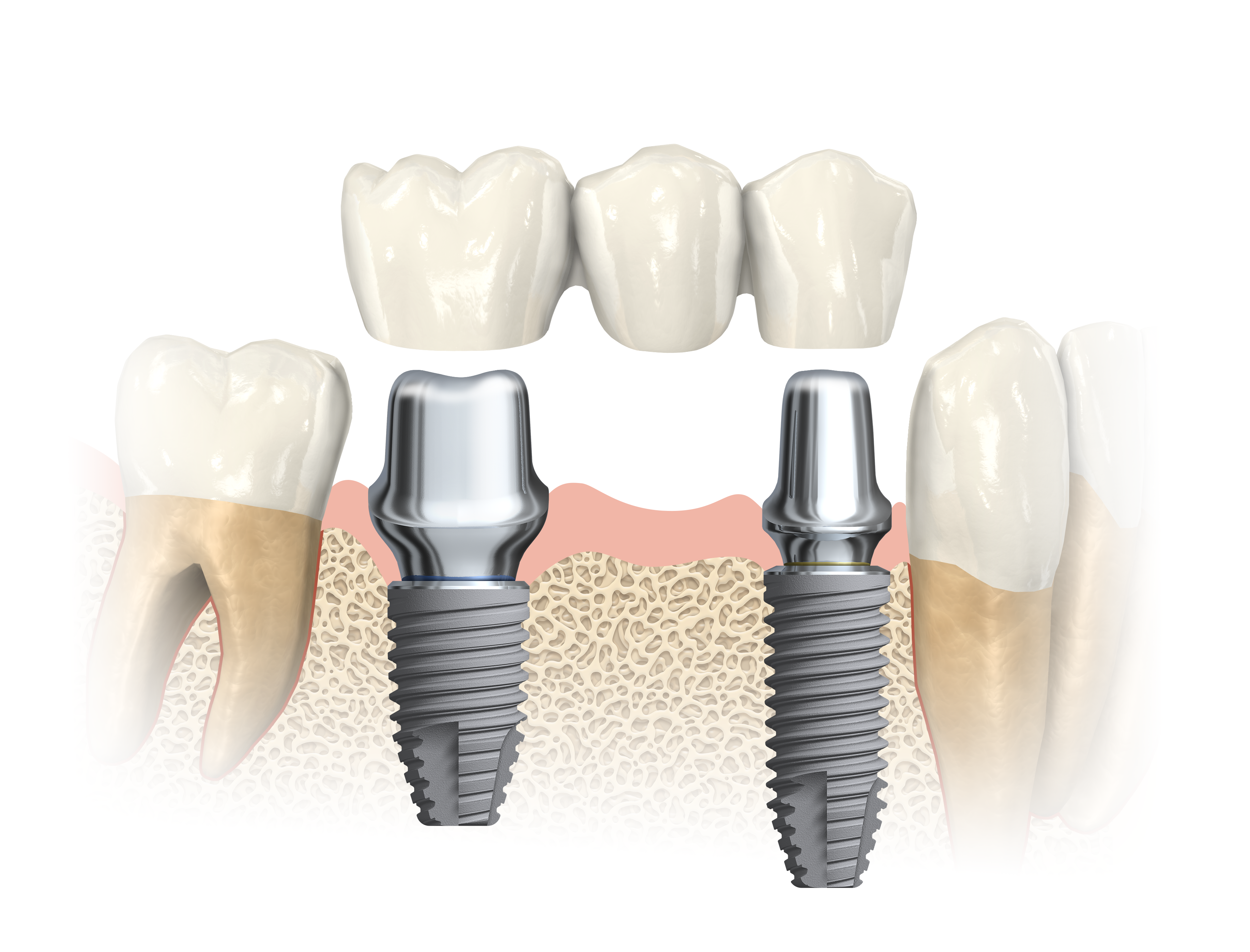 single implant