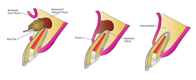 apicectomy