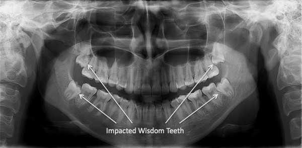 impacted wisdom teeth