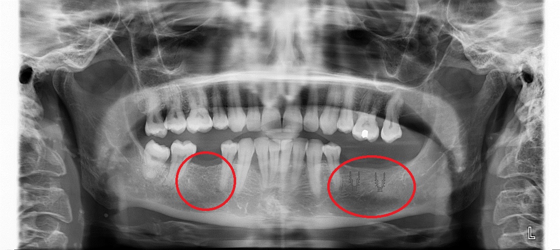 implant before opg