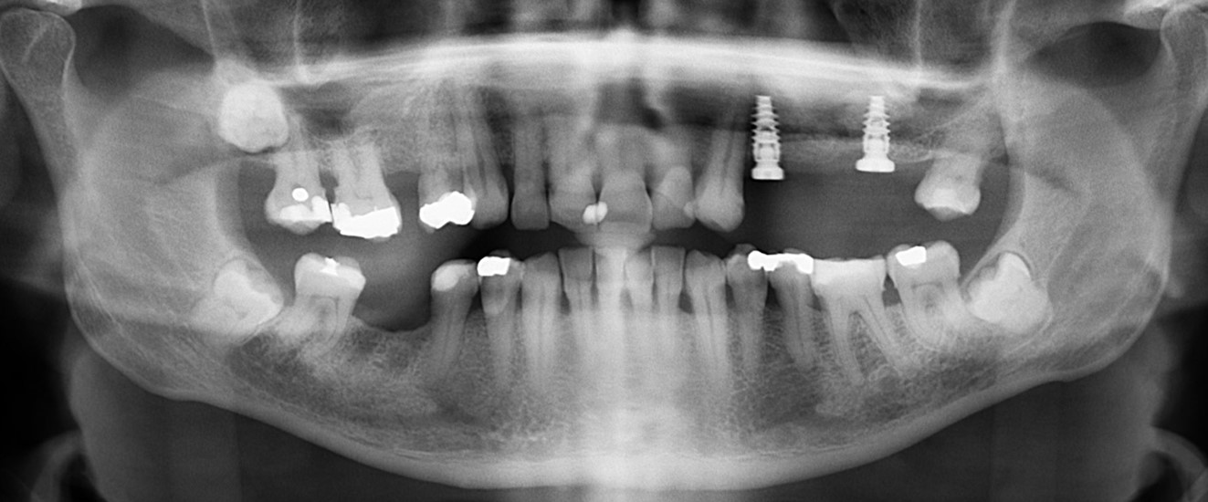 implant retained bridge opg