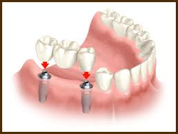 implant bridge nobel