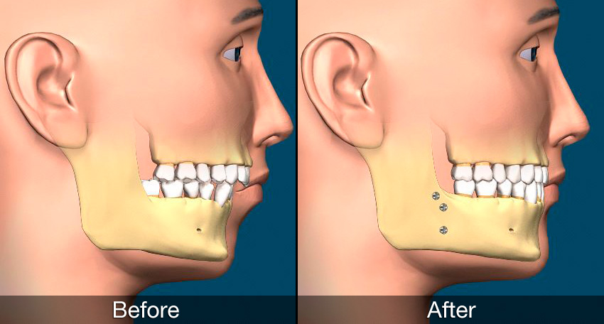 The Benefits and Risks of Jaw Widening - A Comprehensive Guide