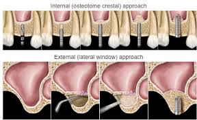 sinus lift