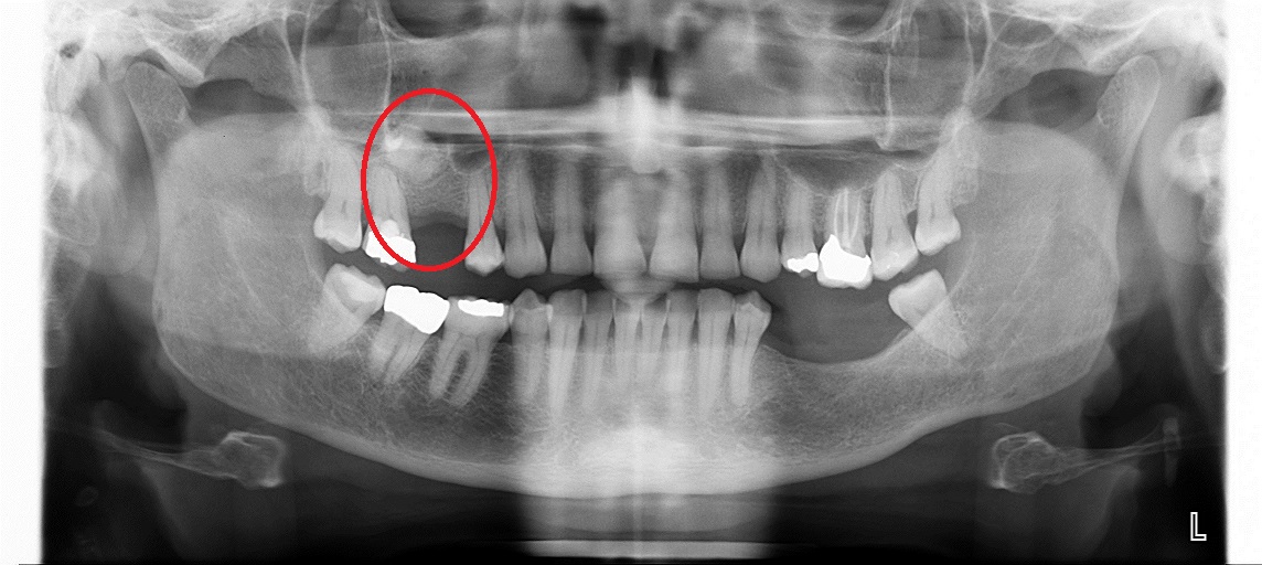 sinus before