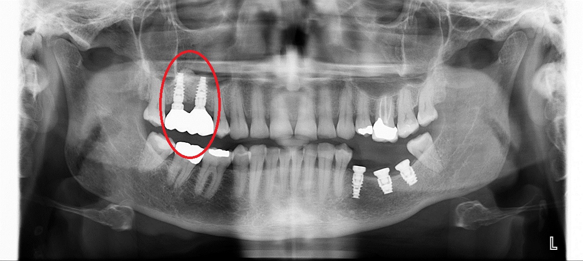 post sinus lift