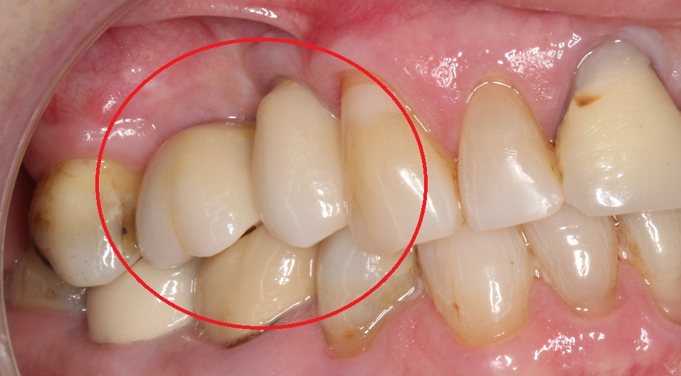 sinus lift post crown